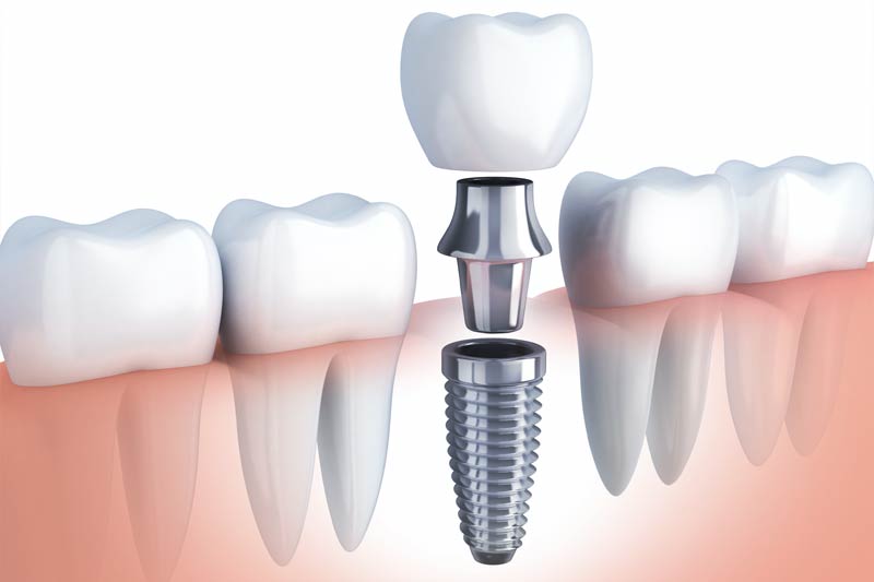 Implants Dentist in Hallandale Beach
