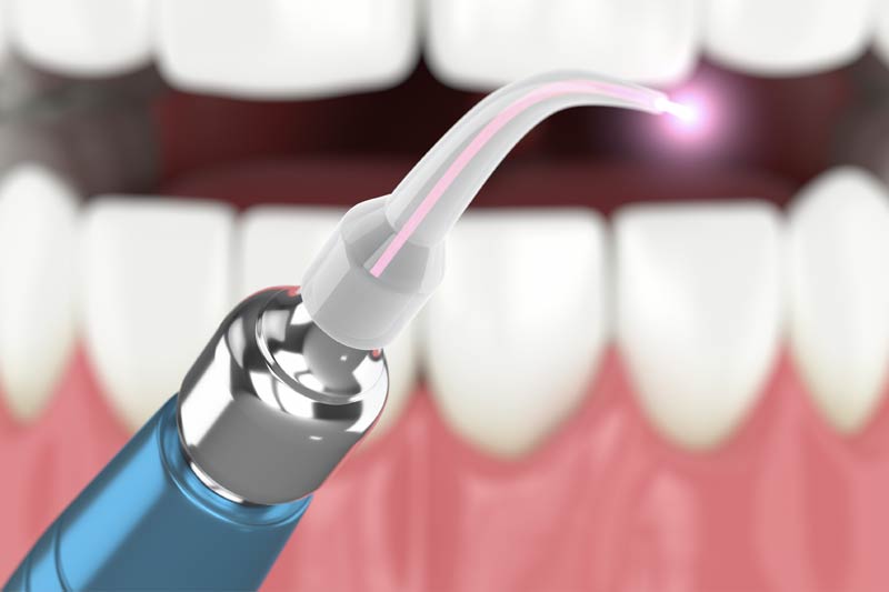 Laser Dentistry in Hallandale Beach