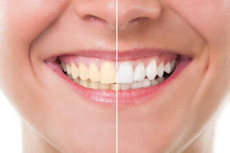 Teeth Whitening in Hallandale Beach